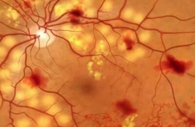 Сетчатка глаза при беременности и родах diabeticheskaya retinopatiya